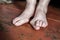 Foot which have bunion hallux valgus problem on floor