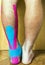 The foot with a wound covered with tape used in elastic therapeutic tape (Kinesio Taping).