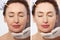 Forehead plastic surgery before and after. Middle age woman wrinkled face close up. Facial contouring, anti aging fillers concept