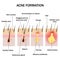 Formation of acne