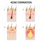 Formation of acne