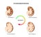 Four stages of kidney hydronephrosis. Vector illustration of the mild  moderate  severe  and terminal kidney disease