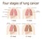 Four stages of lung cancer