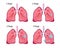 Four stages of lung cancer disease.