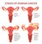 Four stages of womans ovarian cancer isolated