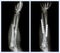 Fracture both bone of forearm. It was operated and internal fixed with plate and