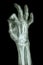 Fracture distal pharange of middle finger