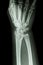 Fracture distal radius (forearm\'s bone)