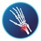 Fracture of distal radius with hand bone icon. Vector flat design for radiology orthopedic research hospital