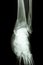 Fracture distal tibia and fibula (leg\'s bone)
