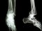 Fracture distal tibia and fibula (leg\'s bone)