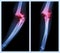 Fracture elbow (Left image : side position , Right image : front position)