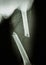 Fracture femur