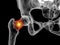 A fracture of the femur neck, a common type of hip fracture that typically occurs in older adults and can lead to