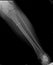 Fracture of fibular bone