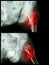 Fracture head of femur(Thigh bone) (intertrochanteric fracture) (2 position)