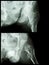 Fracture head of femur(Thigh bone) (intertrochanteric fracture) (2 position)