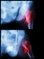 Fracture head of femur(Thigh bone) (intertrochanteric fracture) (2 position)