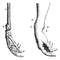 Fracture of the lower extremity of the radius, vintage engraving