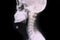 Fracture pedicle of cervical vertebra