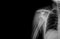 Fracture proximal humerus arm in osteopenia patient. Elderly broken bone.