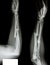 Fracture radius & ulnar bone