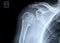 Fracture of a right human upper arm after accident