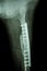 Fracture shaft of femur. It was operated and internal fixation