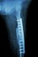 Fracture shaft of femur. It was operated and internal fixation