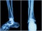 Fracture shaft of fibula bone ( leg bone ) . X-ray of leg ( 2 position : side and front view