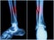 Fracture shaft of fibula bone ( leg bone ) . X-ray of leg ( 2 position : side and front view )