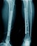 Fracture tibia bone