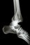 Fracture tibia & fibula (leg\'s bone) and ankle dislocation