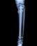 Fracture tibia with implant