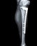Fracture tibia with implant
