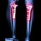 Fracture tibia(leg bone)