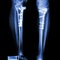 Fracture tibia(leg bone). It was operated and internal fixed