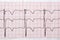 Fragment of a normal children`s electrocardiogram with arrhythmia elements.