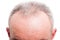 Front hair loss as male medical problem concept