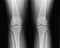 Front knee joint x-ray of mature female with osteoarthritis