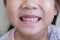 Front teeth of child girl. Little girl`s smile. 3 year old