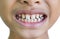 Front teeth gaps