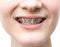 Front view of metal dental braces on teeth cutout