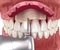 Frontal crown lengthening, Esthetic surgery. Medically accurate dental 3D illustration