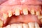 Frontal teeth