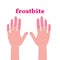 Frostbite. Hands with different skin colors due to low temperature and frost