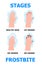 Frostbite stages info-graphic vector. Hypothermia in winter season. Problems with skin of frost fingers