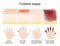 Frostbite stages. skin injury after freezing