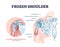 Frozen shoulder condition or adhesive capsulitis syndrome outline diagram