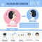 FUE female alopecia treatment medical poster in cartoon style
